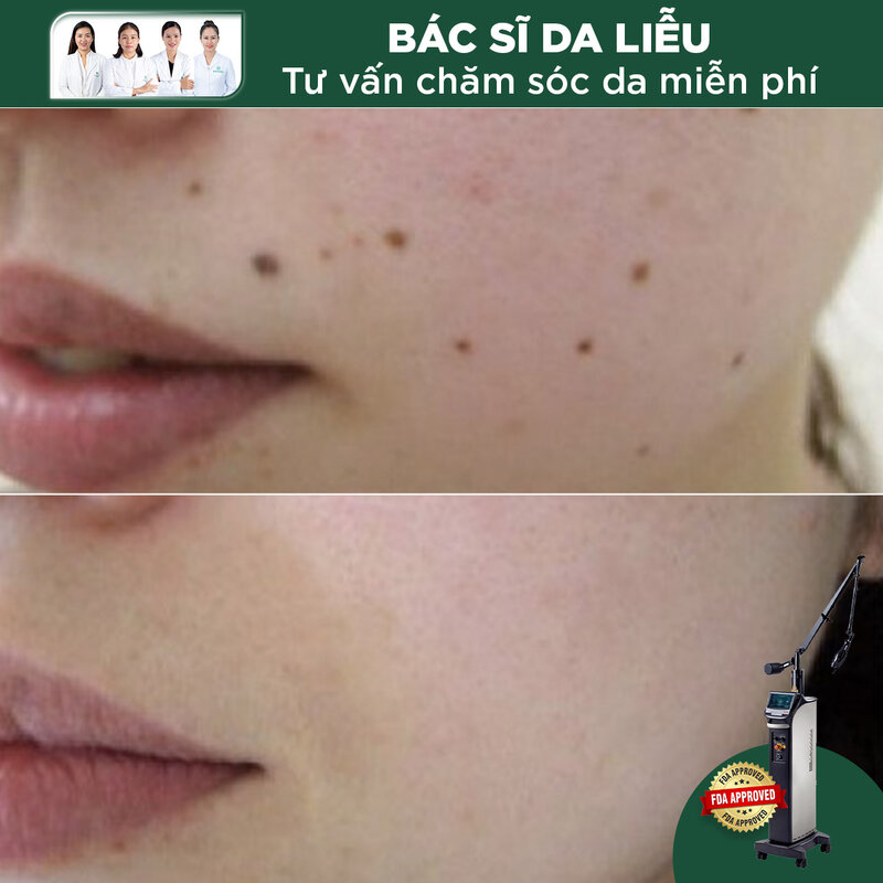 Xóa Nốt Ruồi Công Nghệ Laser Fractional CO2