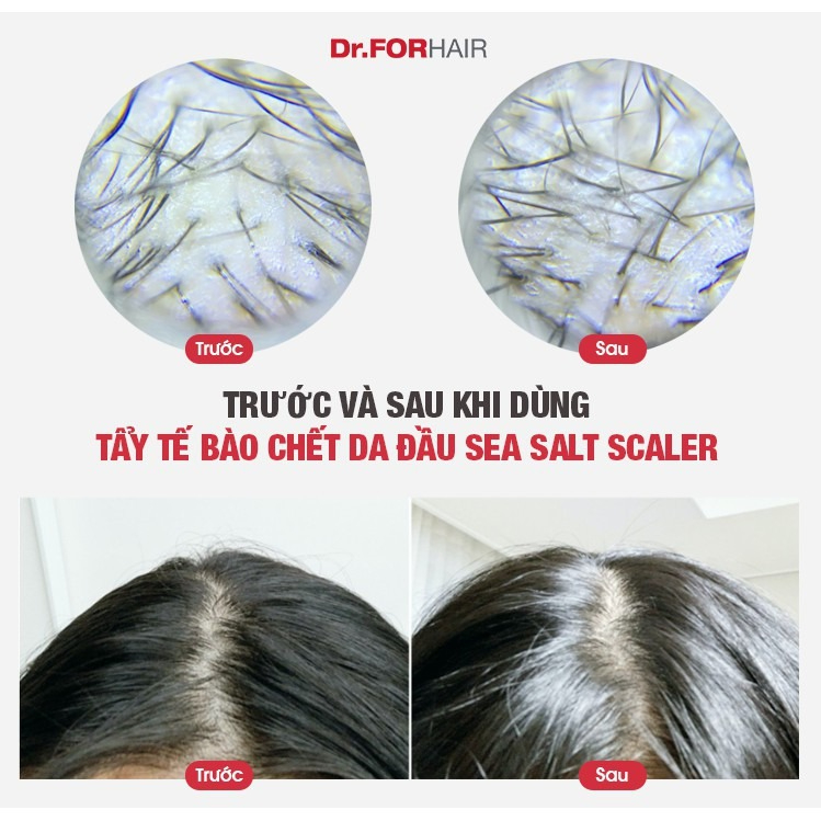 Trước và sau khi sử dụng Tẩy Tế Bào Chết Da Đầu Dr.FORHAIR Sea Salt Scaler