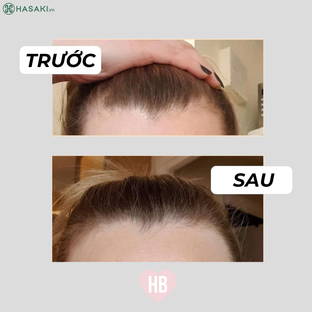 Bộ Gội Xả Hairburst với hơn 95% thành phần tự nhiên giúp kích thích tóc mọc nhanh nhất trong thời gian ngắn nhất, đồng thời cung cấp đủ dưỡng chất để tóc mọc khỏe nhất.