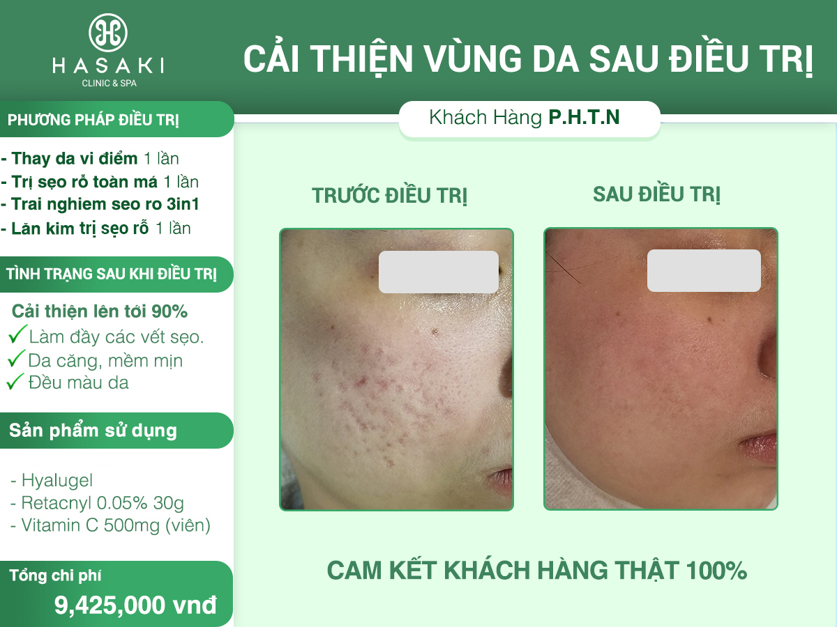 Điều Trị Sẹo Rỗ 3 Trong 1 Hiệu Quả