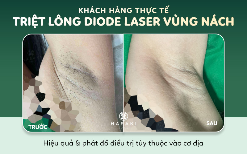Hiệu quả triệt lông Diode Laser tại Hasaki Clinic