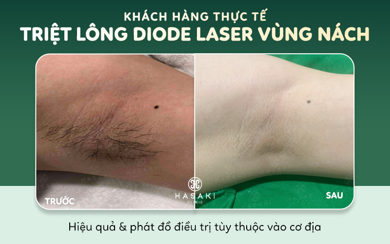 Hiệu quả triệt lông nữ Diode Laser tại Hasaki Clinic