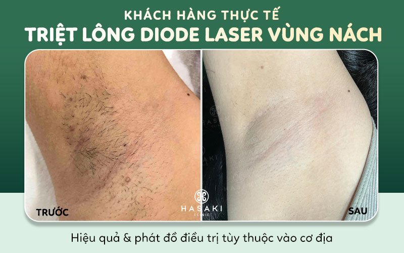 Hiệu quả triệt lông Diode Laser vùng nách nữ tại Hasaki Clinic
