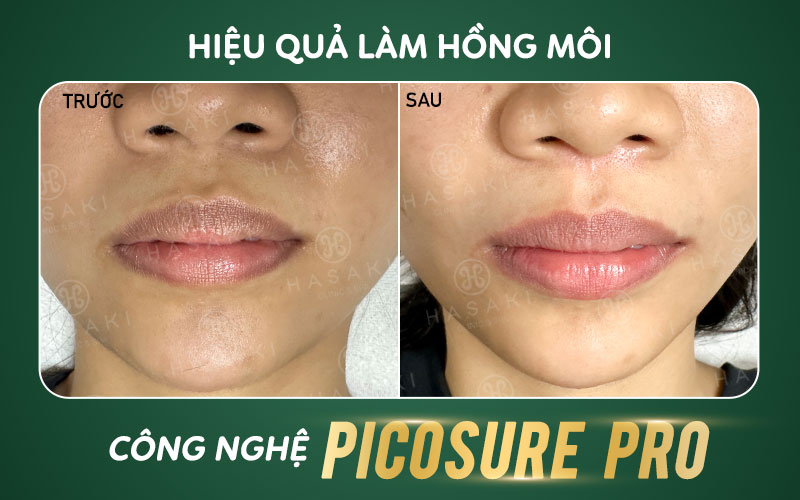Hiệu quả làm hồng môi bằng Picosure Pro tại Hasaki Clinic