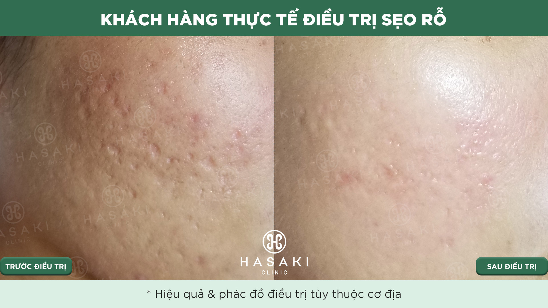 Khách hàng thực tế Điều Trị Sẹo Lõm tại Hasaki Clinic