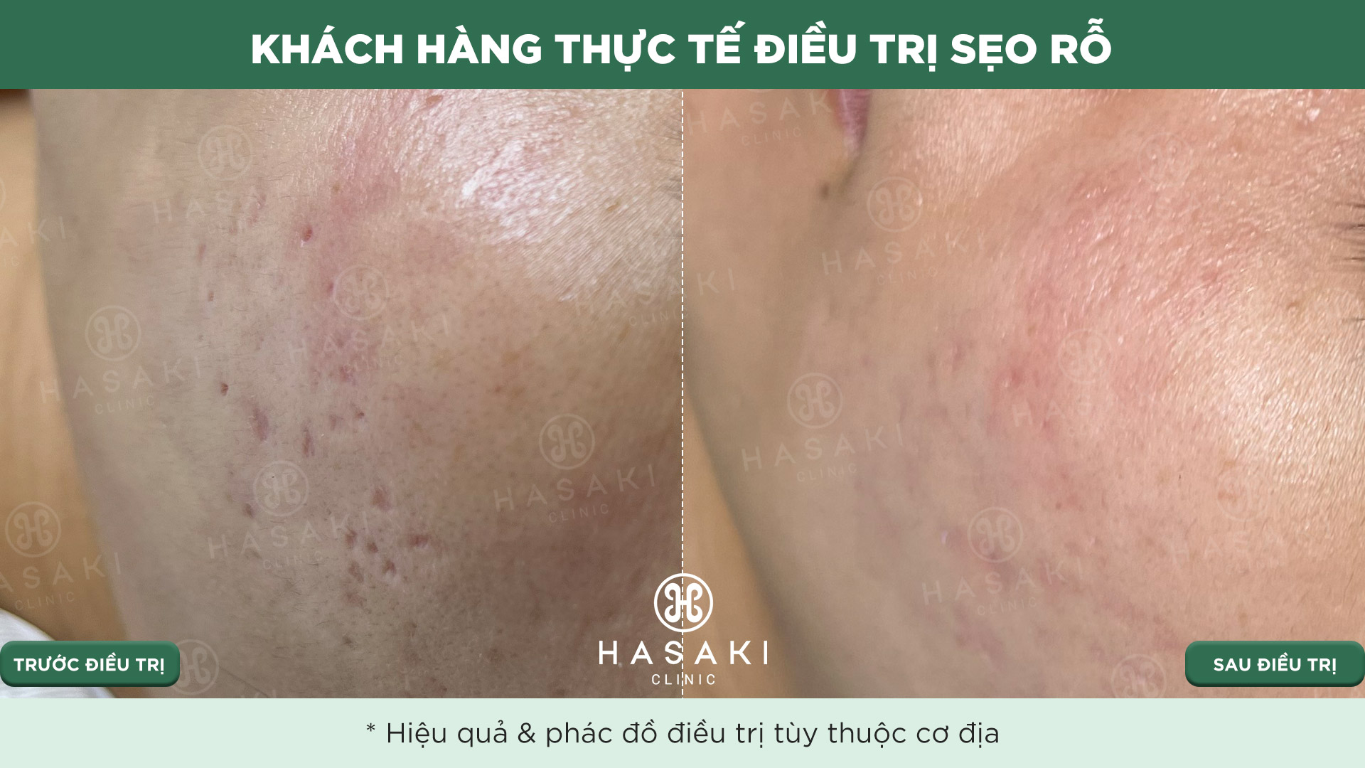 Khách hàng thực tế Điều Trị Sẹo Lõm tại Hasaki Clinic