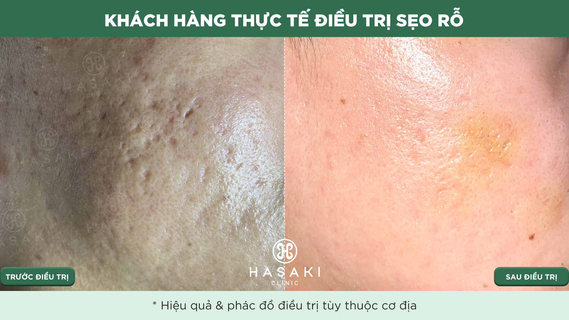 Khách hàng thực tế Điều Trị Sẹo Lõm tại Hasaki Clinic