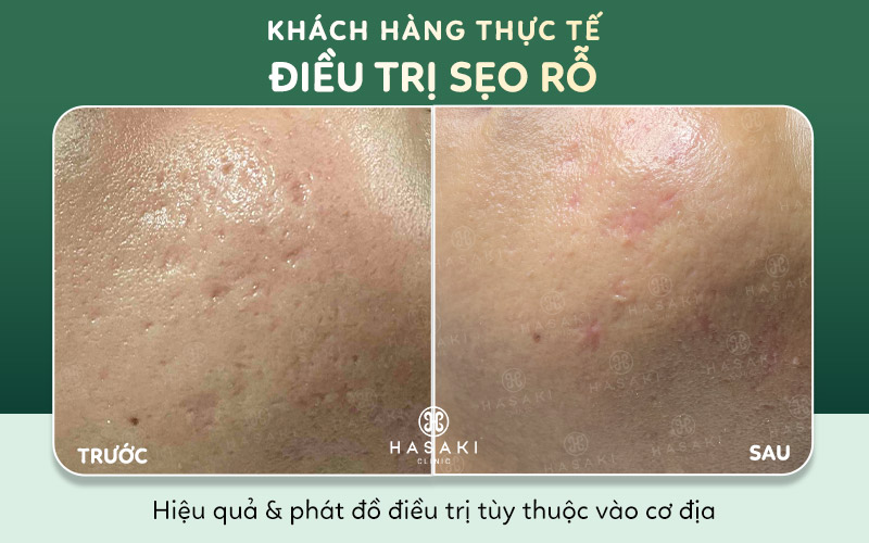 Khách hàng thực tế Điều Trị Sẹo Lõm tại Hasaki Clinic