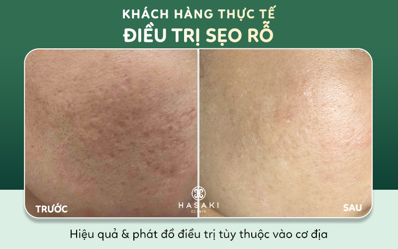 Hiệu quả điều trị sẹo rỗ tại Hasaki Clinic