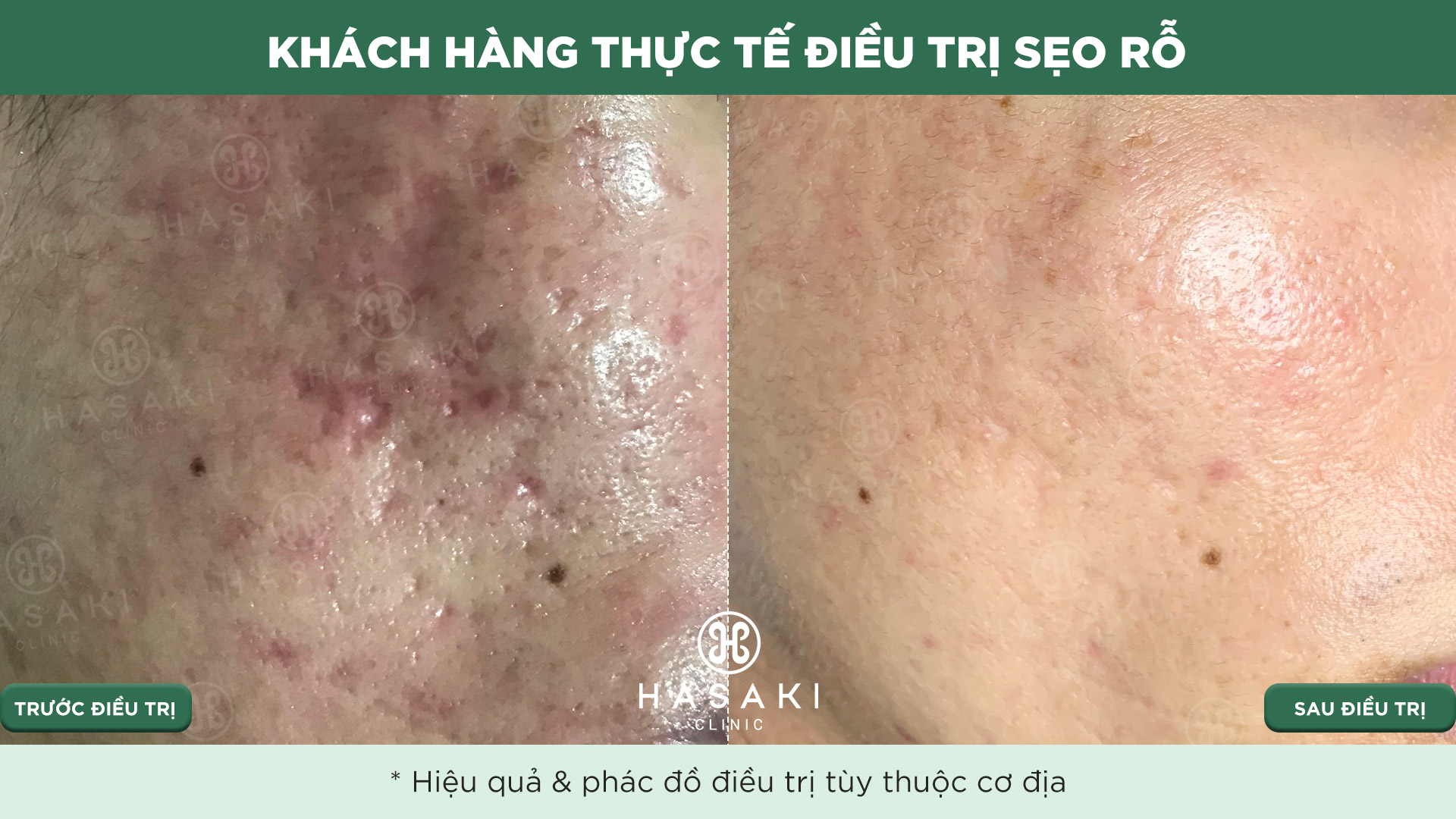 Khách hàng thực tế Điều Trị Sẹo Lõm tại Hasaki Clinic