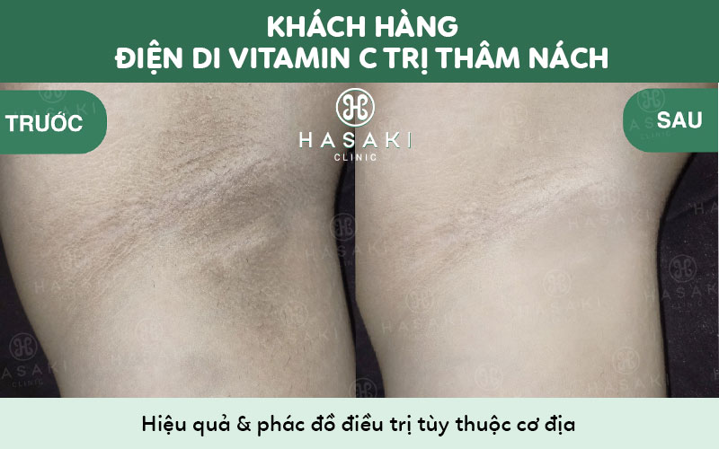 Hiệu quả điện di vitamin C trị thâm nách tại Hasaki Clinic