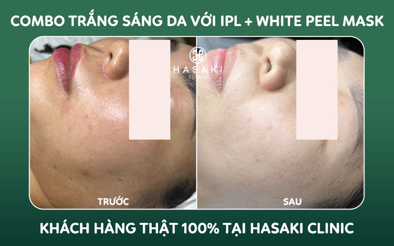 Hiệu quả Combo Trắng Sáng Da Với IPL + White Peel Mask tại Hasaki Clinic