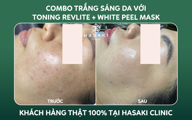 Hiệu quả Combo Trắng Sáng Da Với Toning Revlite + White Peel Mask tại Hasaki Clinic