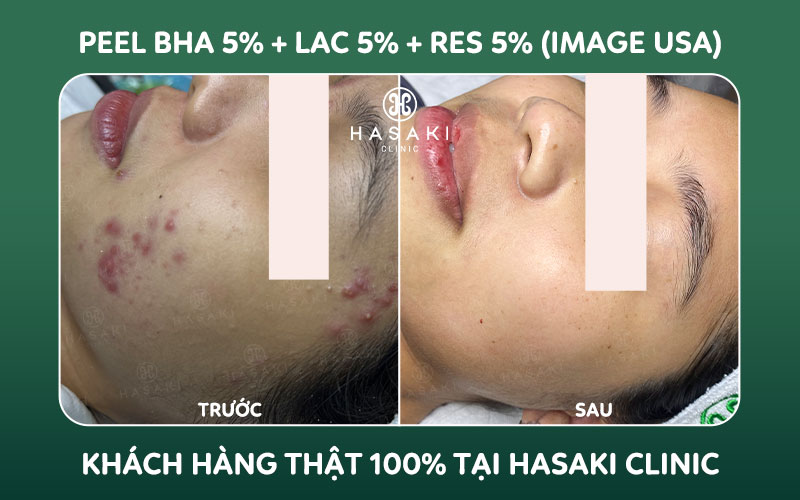 Hiệu quả Peel BHA 5% + LAC 5% + Res 5% (Image USA) tại Hasaki Clinic