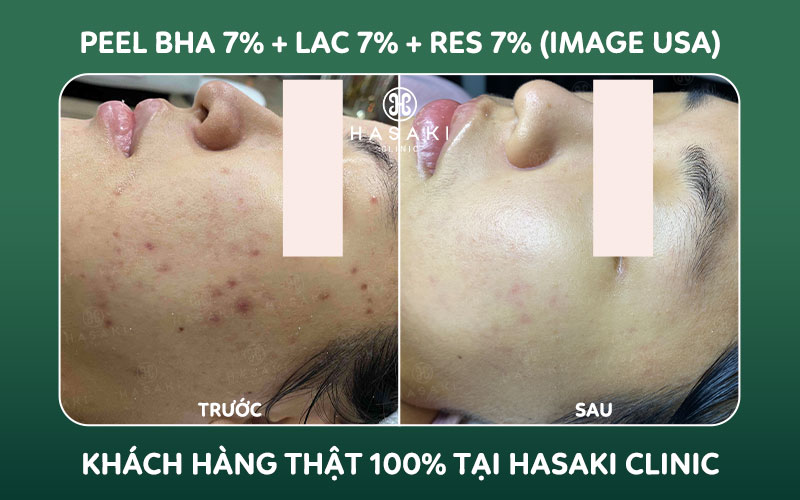 Hiệu quả Peel BHA 7% + LAC 7% + Res 7% (Image USA) tại Hasaki Clinic