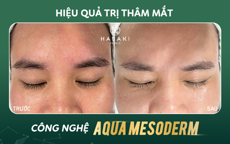 Khách hàng điều trị thâm mắt công nghệ Aqua Mesoderm tại Hasaki Clinic