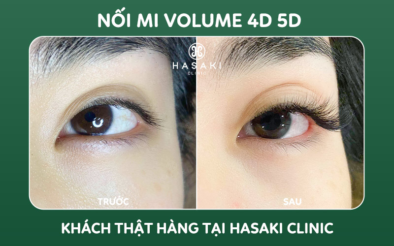 Khách hàng thực tế nối mi volume 4D 5D tại Hasaki Clinic