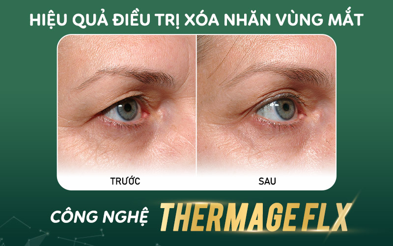 Khách hàng sau 1 lần điều trị  Thermage FLX vùng mắt
