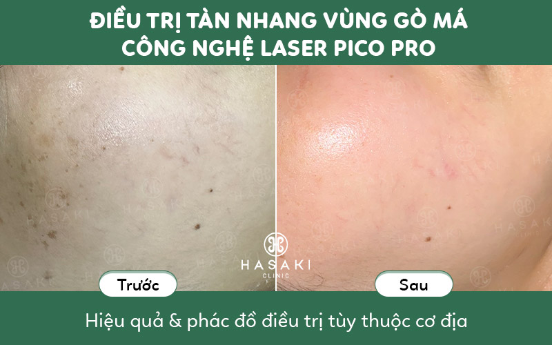 Điều trị tàn nhang công nghệ Laser Pico Pro an toàn, hiệu quả tại Hasaki Clinic