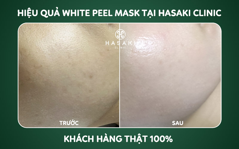 Khách hàng điều trị sáng da white peel mask tại Hasaki Clinic