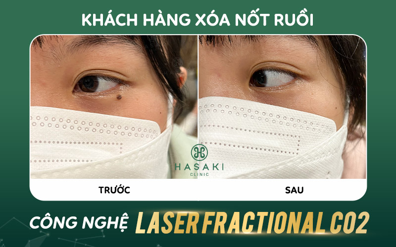 Hiệu quả xóa nốt ruồi công nghệ Laser Fractional C02 tại Hasaki Clinic