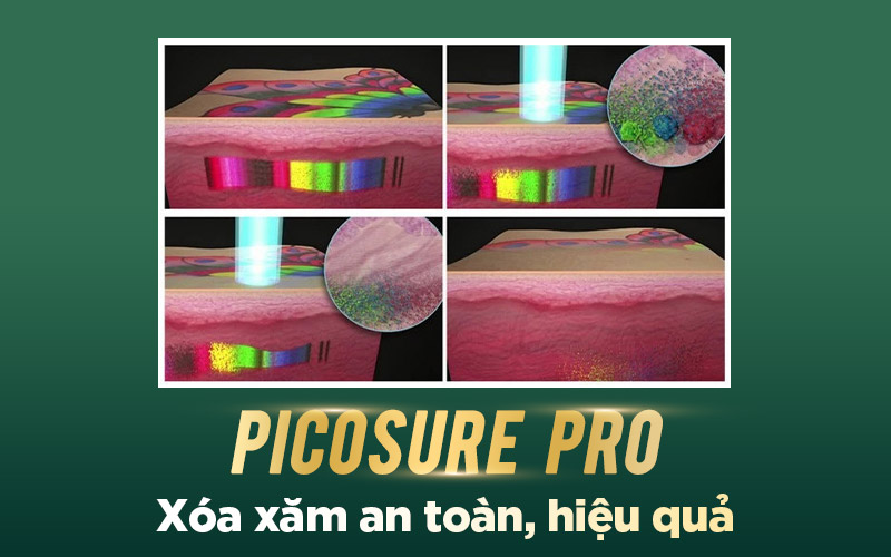 Picosure Pro phá vỡ mực xăm an toàn, hiệu quả