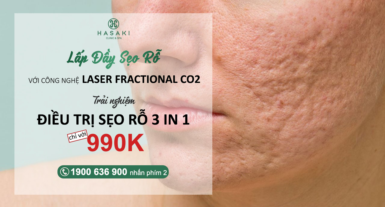 Trải nghiệm điều trị sẹo rỗ 3 in 1 tại Hasaki Clinic & Spa