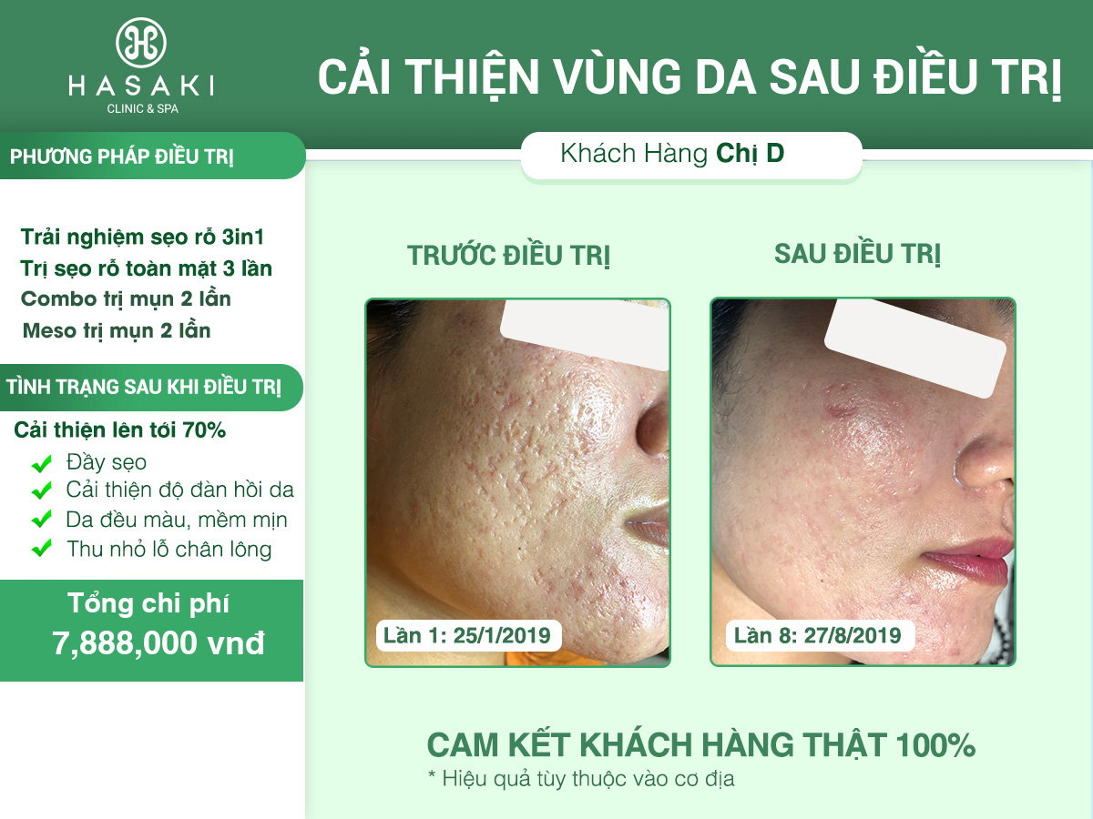 Điều trị sẹo rỗ 3 trong 1 với Laser Fractional CO2